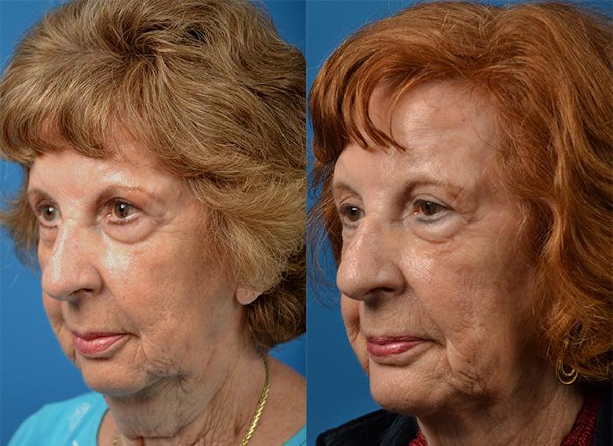 Chin Augmentation Before & After Gallery - Patient 122405546 - Image 2