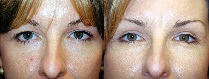 Brow Lift Before & After Gallery - Patient 122405548 - Image 1