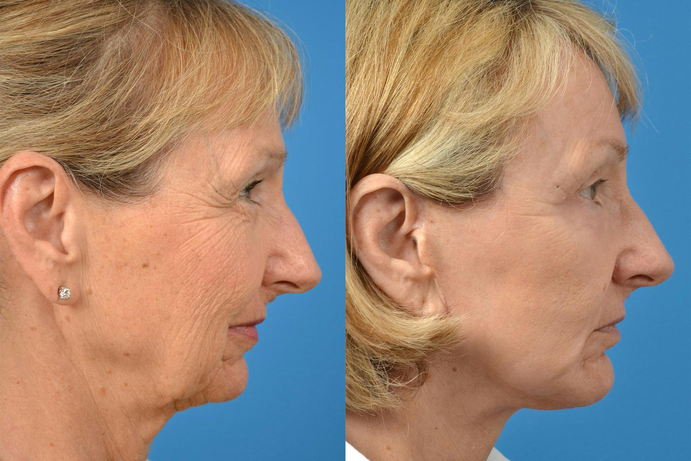 Chin Augmentation Before & After Gallery - Patient 122405554 - Image 1