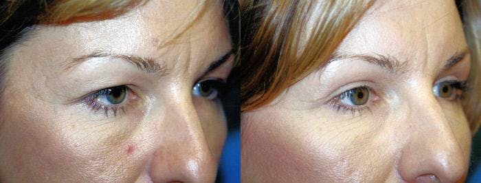 Brow Lift Before & After Gallery - Patient 122405548 - Image 2