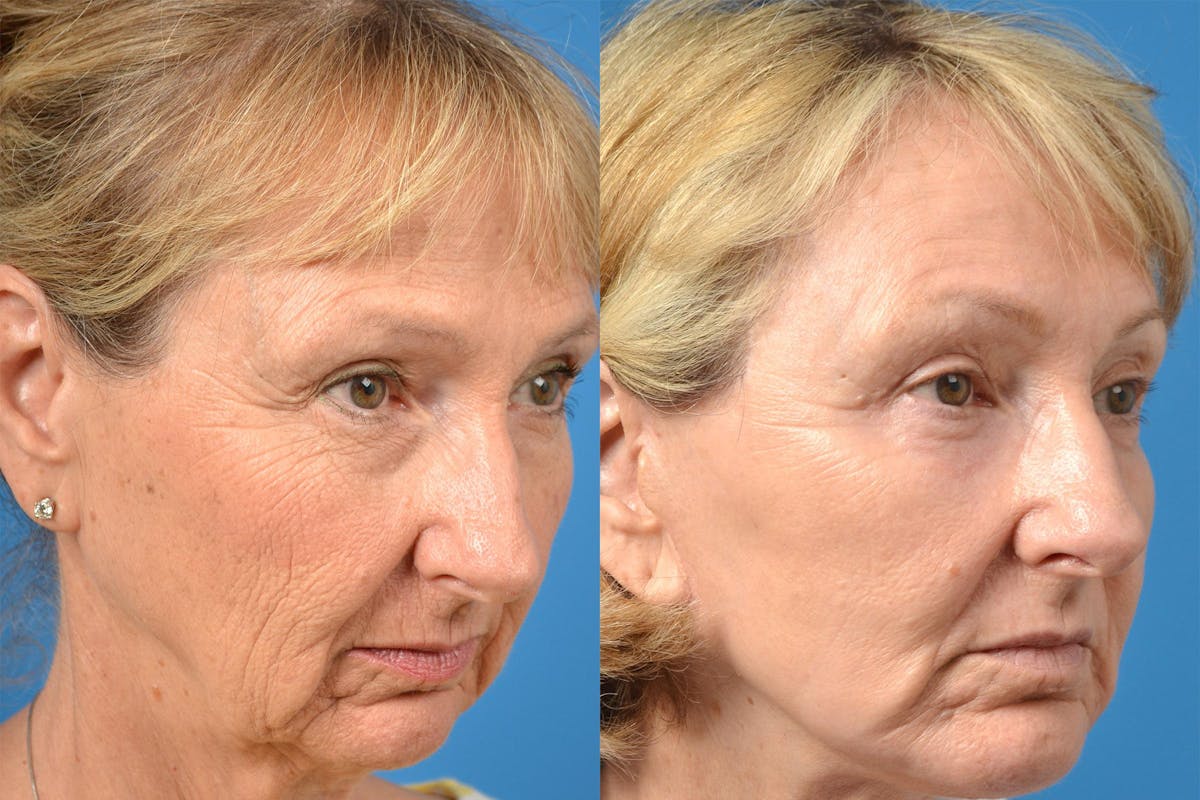 Chin Augmentation Before & After Gallery - Patient 122405554 - Image 2
