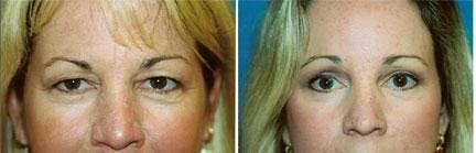 Brow Lift Before & After Gallery - Patient 122405550 - Image 1