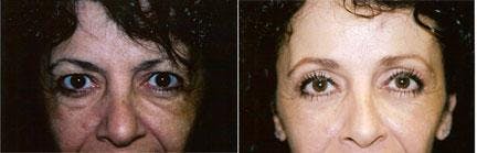 Brow Lift Before & After Gallery - Patient 122405551 - Image 1