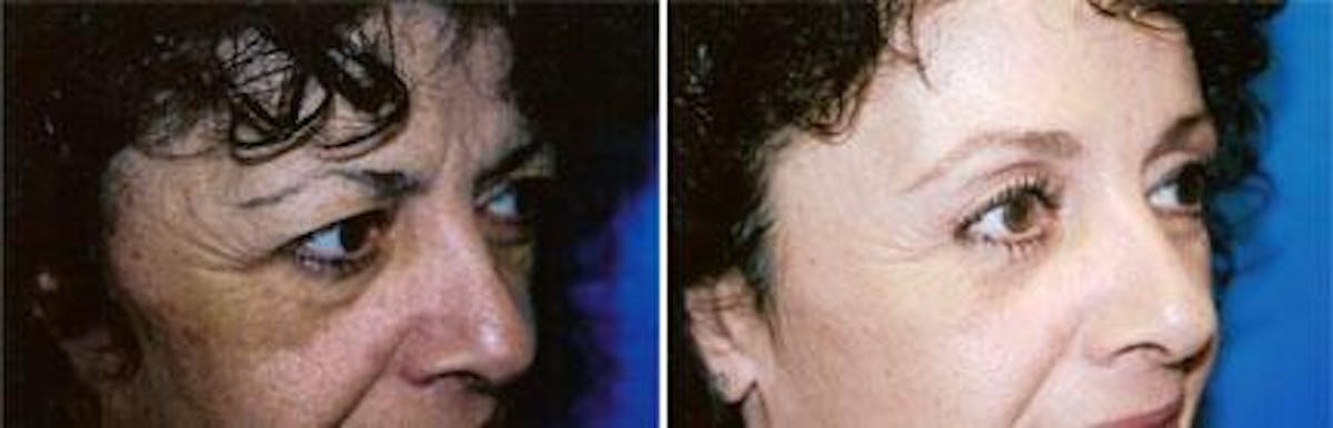 Brow Lift Before & After Gallery - Patient 122405551 - Image 2