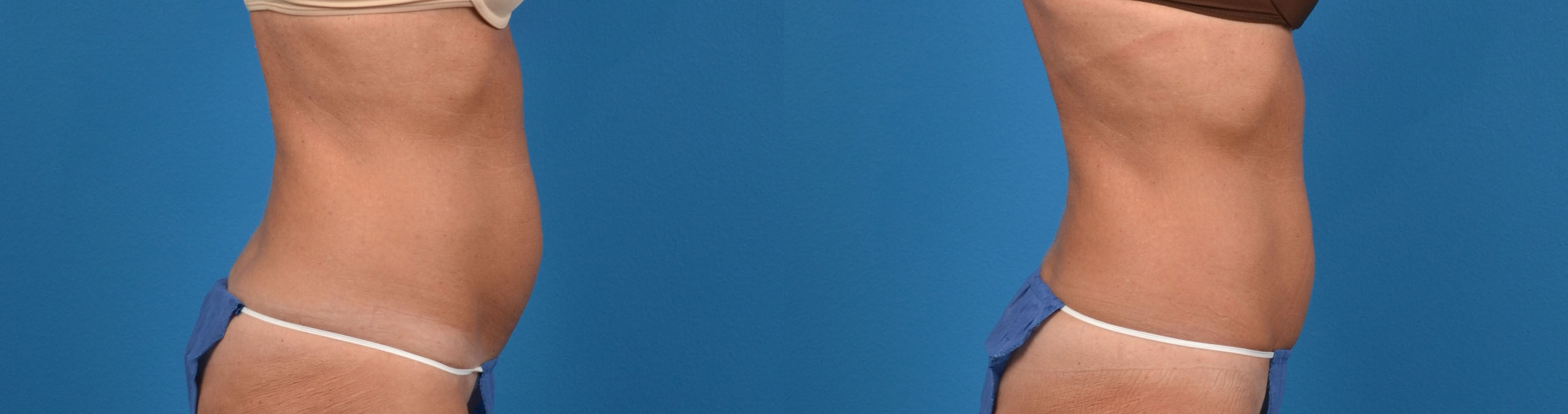 CoolTone Before & After Gallery - Patient 122405556 - Image 3