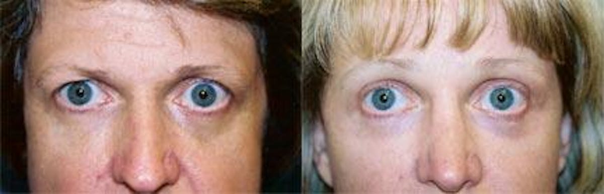 Brow Lift Before & After Gallery - Patient 122405553 - Image 1