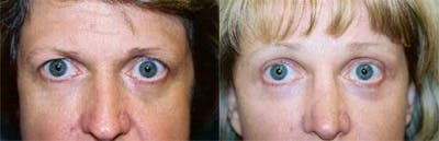 Brow Lift Before & After Gallery - Patient 122405553 - Image 1