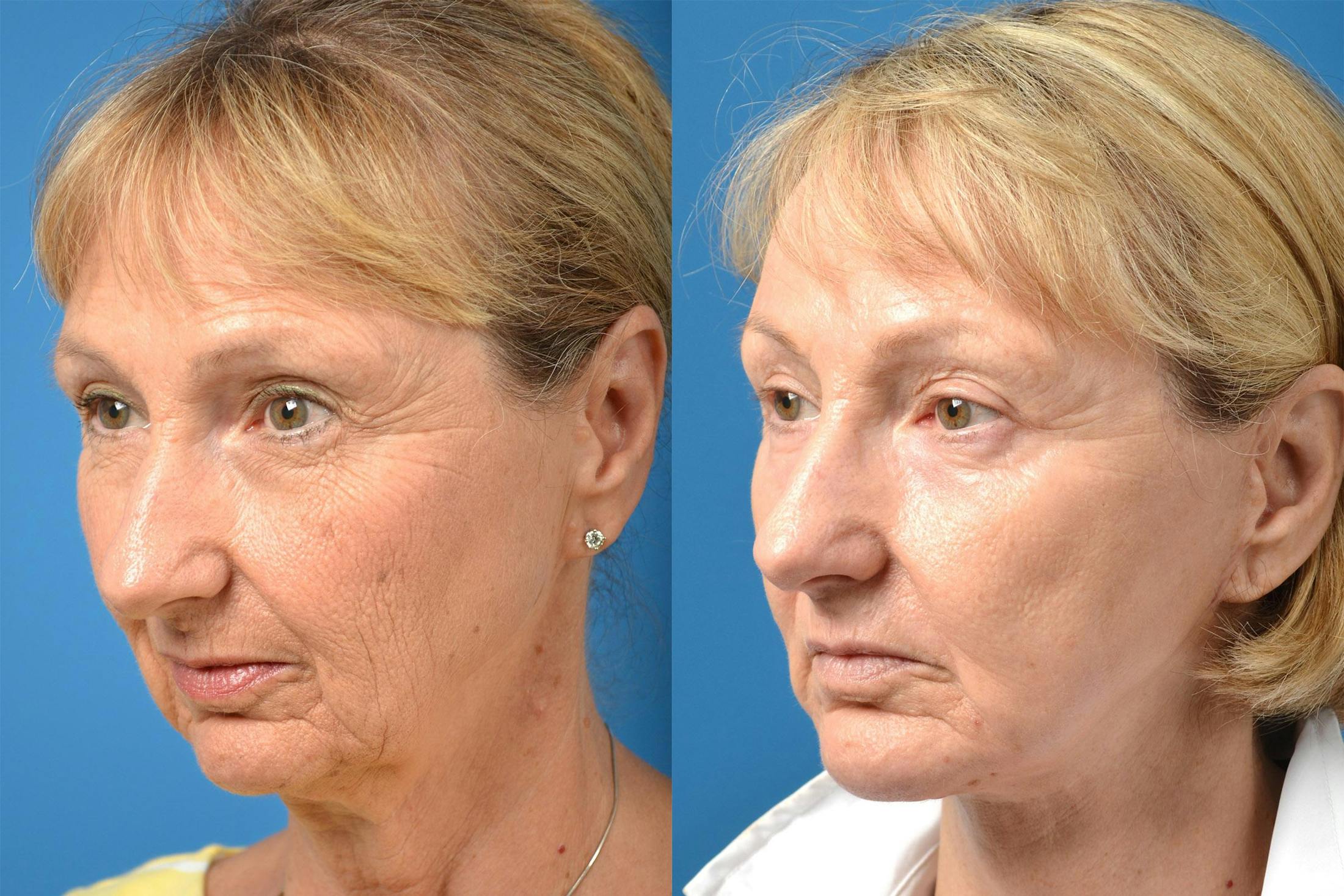 Chin Augmentation Before & After Gallery - Patient 122405554 - Image 4