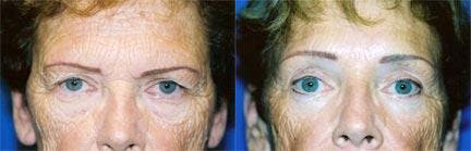 Brow Lift Before & After Gallery - Patient 122405555 - Image 1