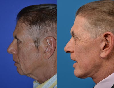 Chin Augmentation Before & After Gallery - Patient 122405561 - Image 1