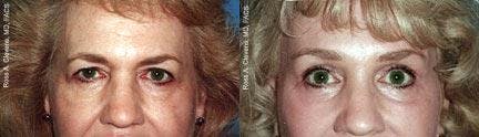 Brow Lift Before & After Gallery - Patient 122405557 - Image 1