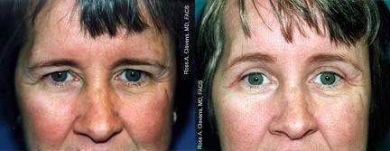 Brow Lift Before & After Gallery - Patient 122405558 - Image 1