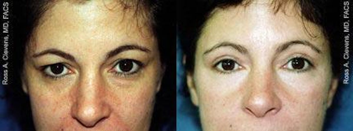 Brow Lift Before & After Gallery - Patient 122405559 - Image 1