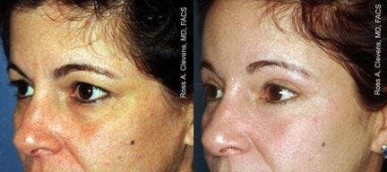 Brow Lift Before & After Gallery - Patient 122405559 - Image 2