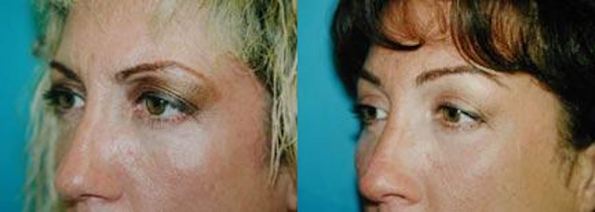 Brow Lift Before & After Gallery - Patient 122405560 - Image 1