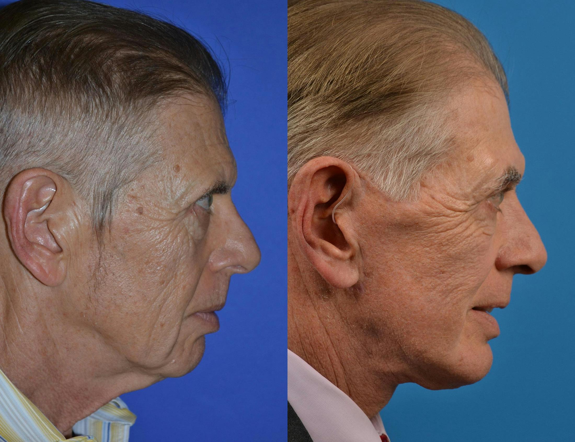 Chin Augmentation Before & After Gallery - Patient 122405561 - Image 5