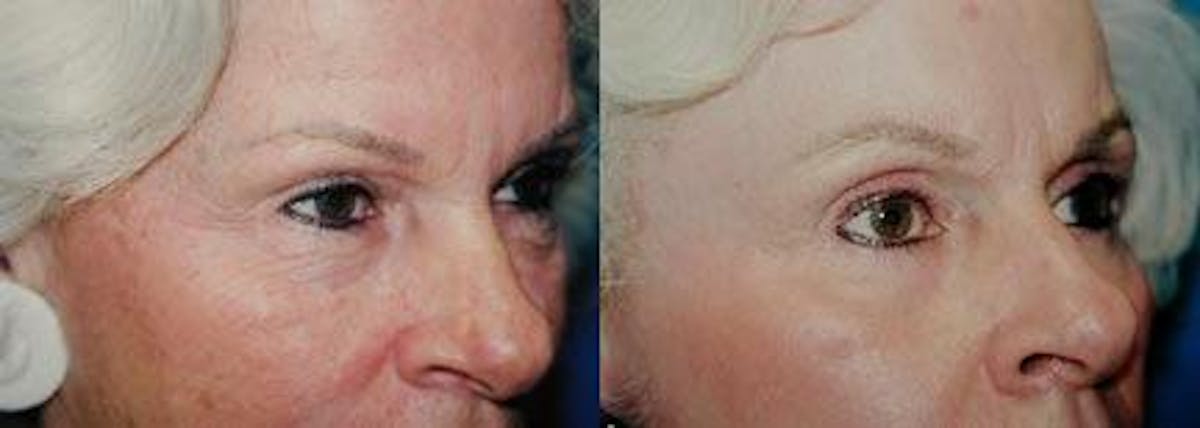 Brow Lift Before & After Gallery - Patient 122405562 - Image 1
