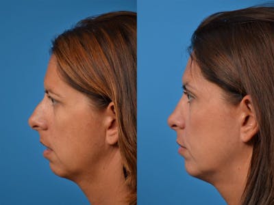 Chin Augmentation Before & After Gallery - Patient 122405568 - Image 1