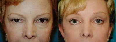 Brow Lift Before & After Gallery - Patient 122405563 - Image 1