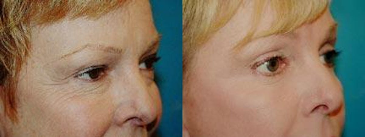Brow Lift Before & After Gallery - Patient 122405563 - Image 2