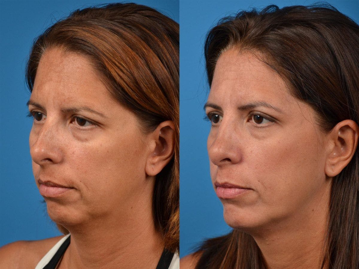Chin Augmentation Before & After Gallery - Patient 122405568 - Image 2