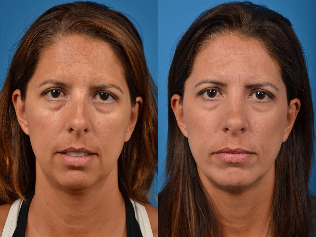 Chin Augmentation Before & After Gallery - Patient 122405568 - Image 3