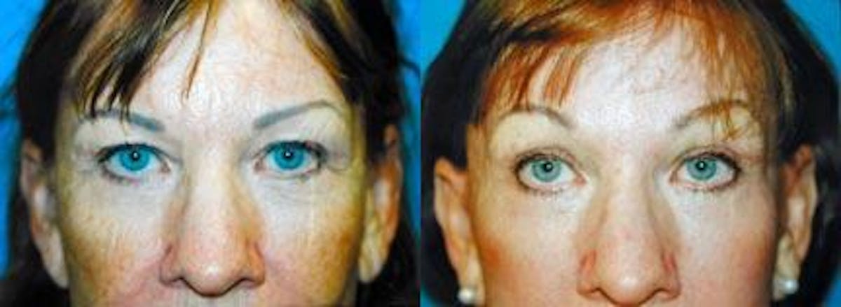 Brow Lift Before & After Gallery - Patient 122405564 - Image 1