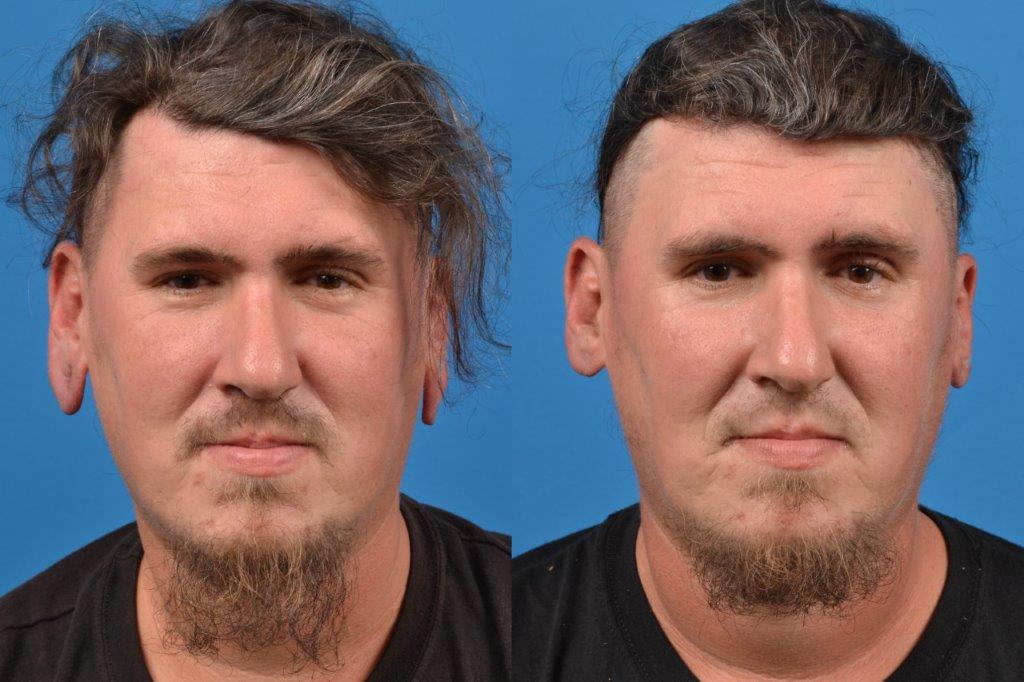 Earlobe Repair Before & After Gallery - Patient 122405566 - Image 1