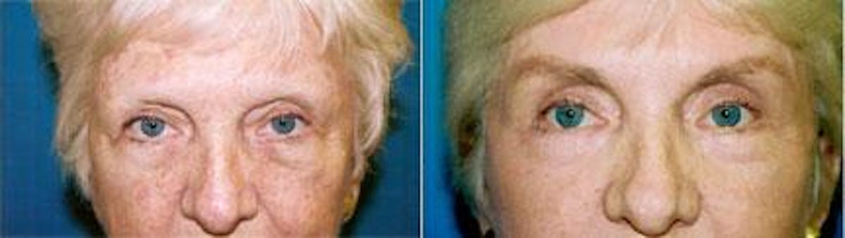 Brow Lift Before & After Gallery - Patient 122405565 - Image 1