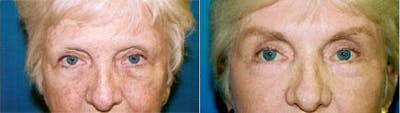 Brow Lift Before & After Gallery - Patient 122405565 - Image 1