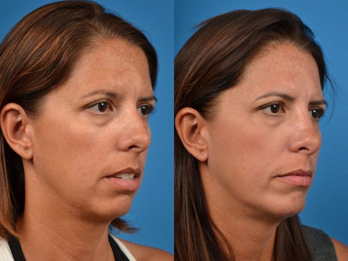 Chin Augmentation Before & After Gallery - Patient 122405568 - Image 4