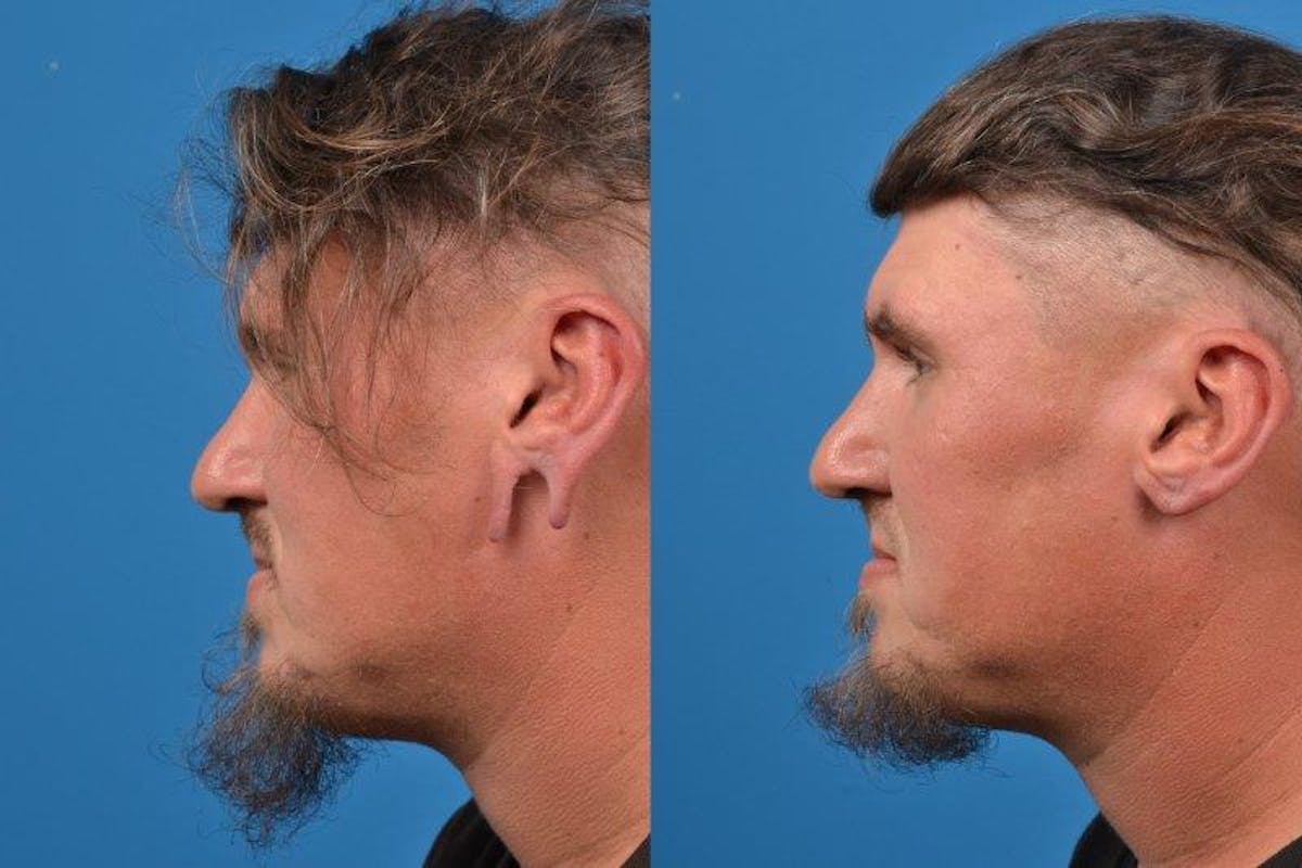 Earlobe Repair Before & After Gallery - Patient 122405566 - Image 3