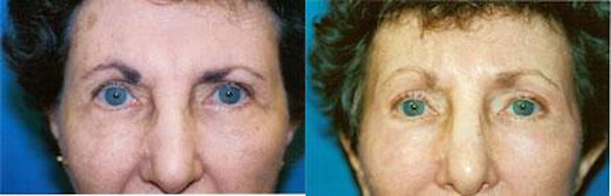 Brow Lift Before & After Gallery - Patient 122405567 - Image 1