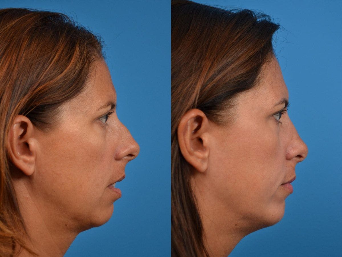 Chin Augmentation Before & After Gallery - Patient 122405568 - Image 5