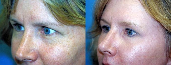 Brow Lift Before & After Gallery - Patient 122405569 - Image 1