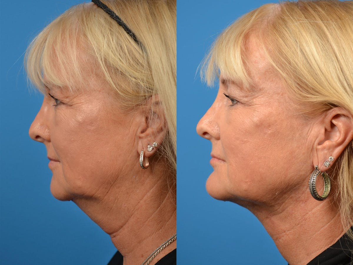 Chin Augmentation Before & After Gallery - Patient 122405571 - Image 1