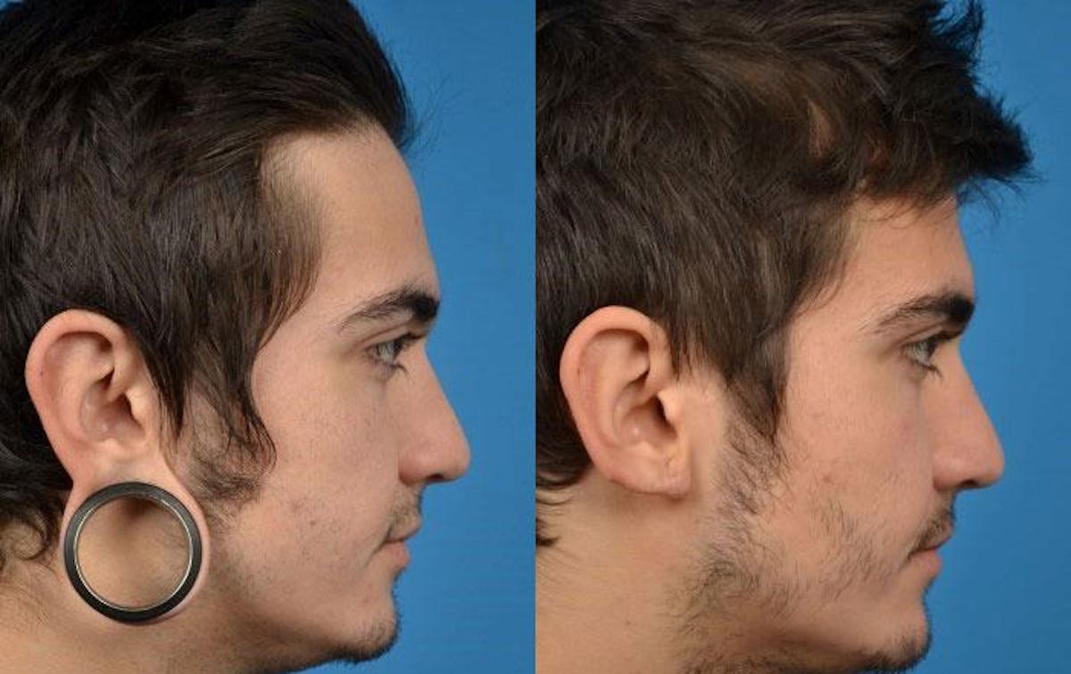 Earlobe Repair Before & After Gallery - Patient 122405570 - Image 2