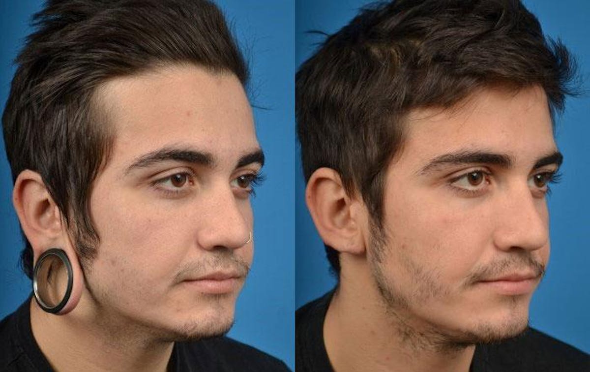 Earlobe Repair Before & After Gallery - Patient 122405570 - Image 3