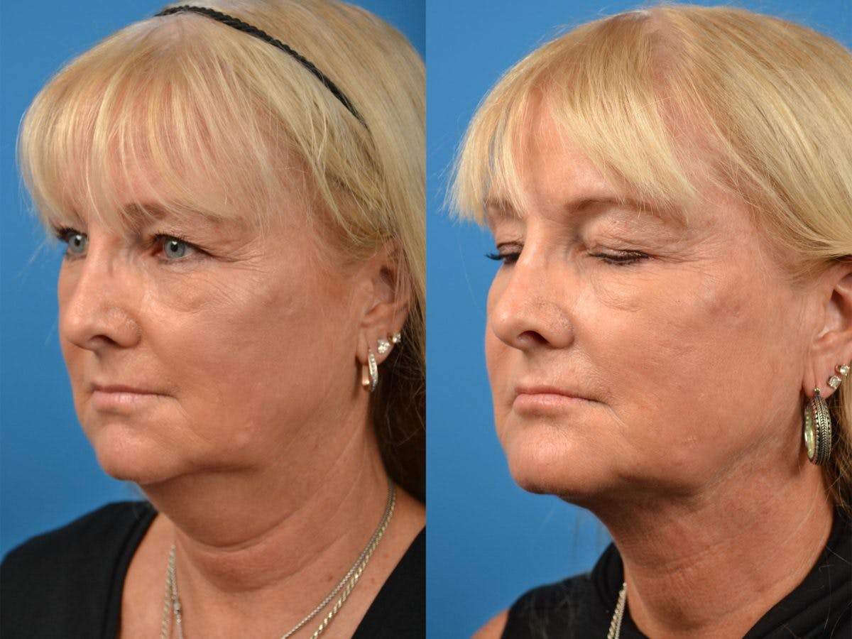 Chin Augmentation Before & After Gallery - Patient 122405571 - Image 2