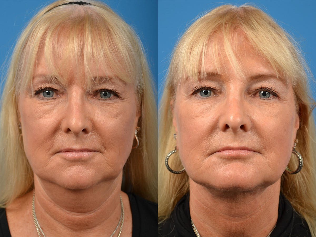 Chin Augmentation Before & After Gallery - Patient 122405571 - Image 3