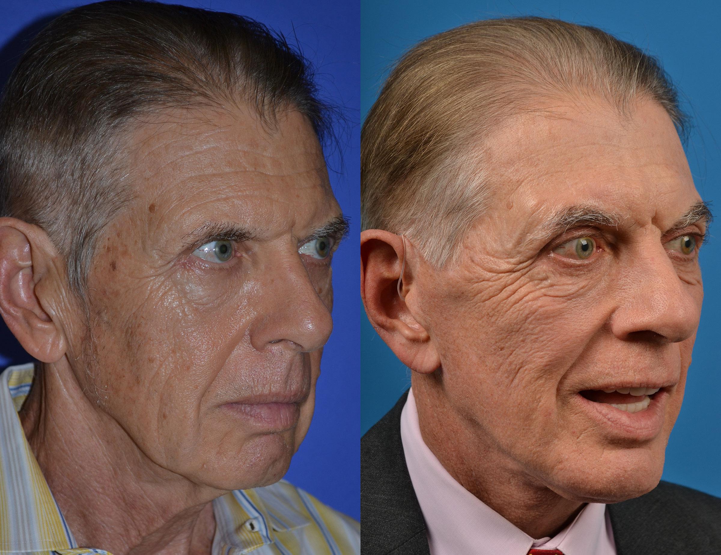 Brow Lift Before & After Gallery - Patient 122405580 - Image 2