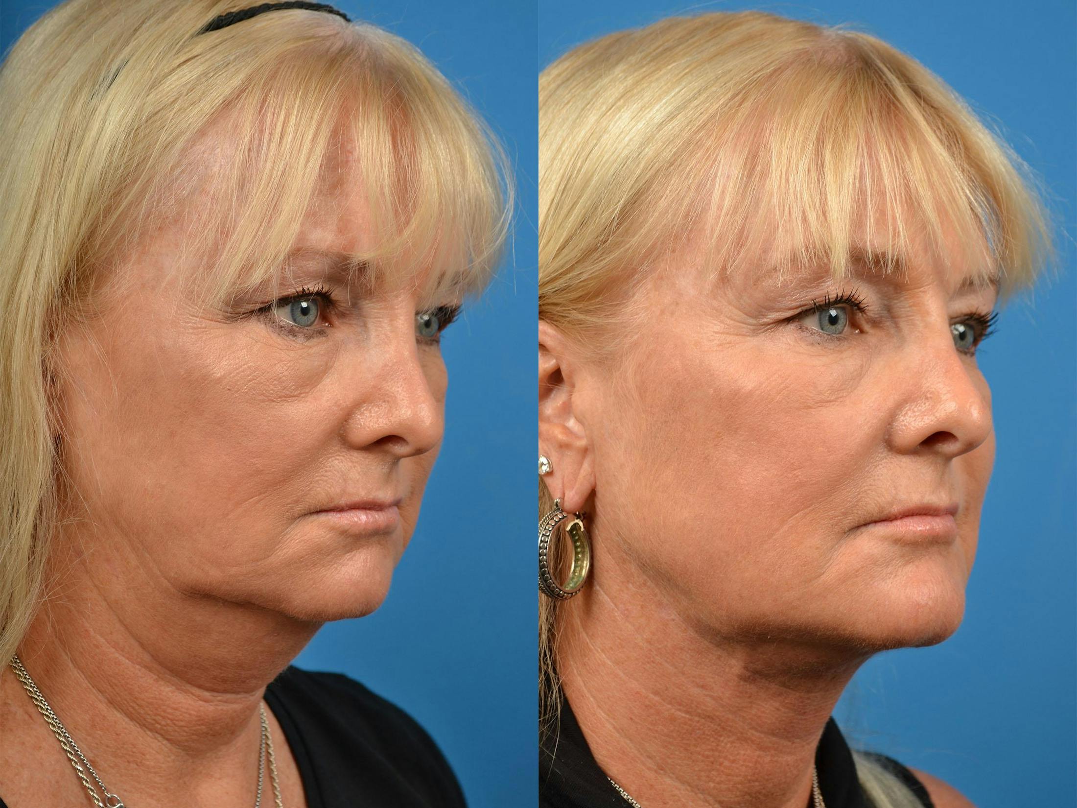Chin Augmentation Before & After Gallery - Patient 122405571 - Image 4