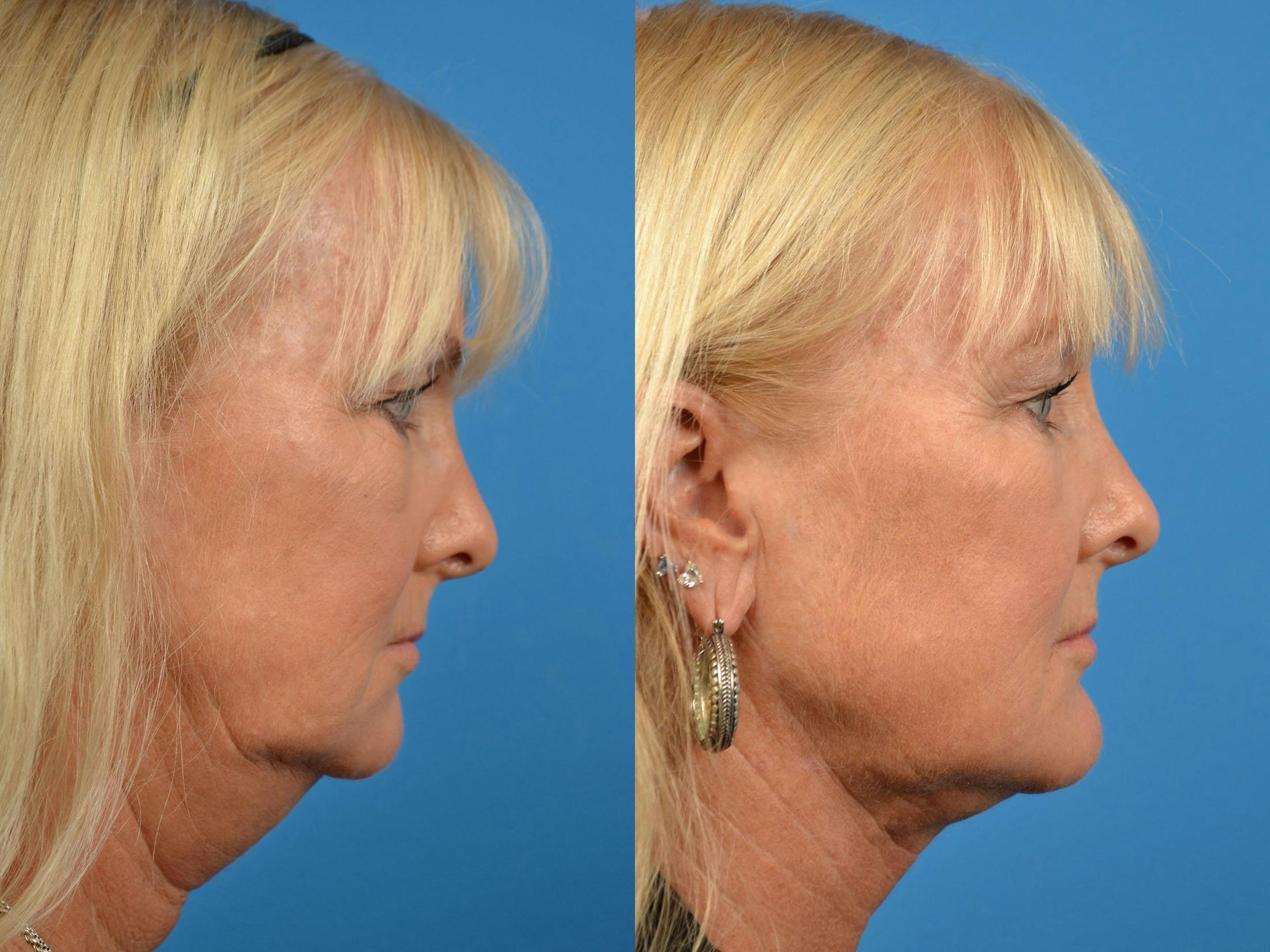 Chin Augmentation Before & After Gallery - Patient 122405571 - Image 5
