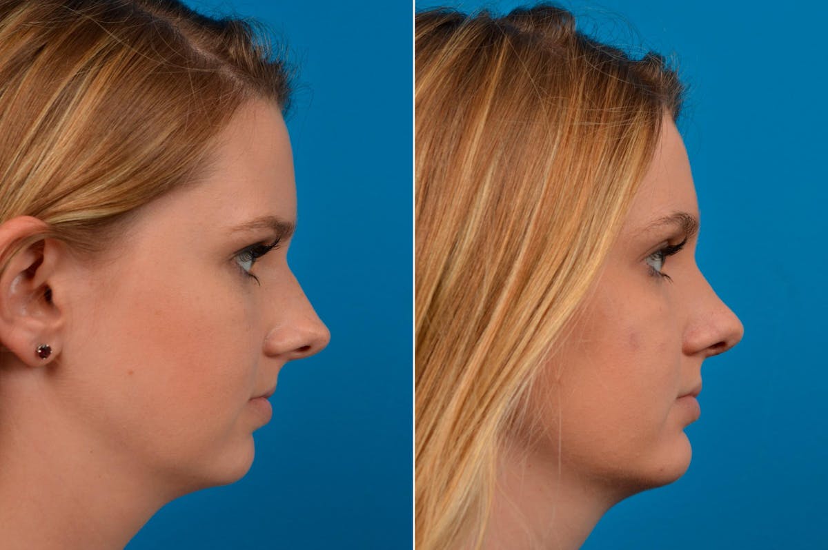 Chin Augmentation Before & After Gallery - Patient 122405576 - Image 1