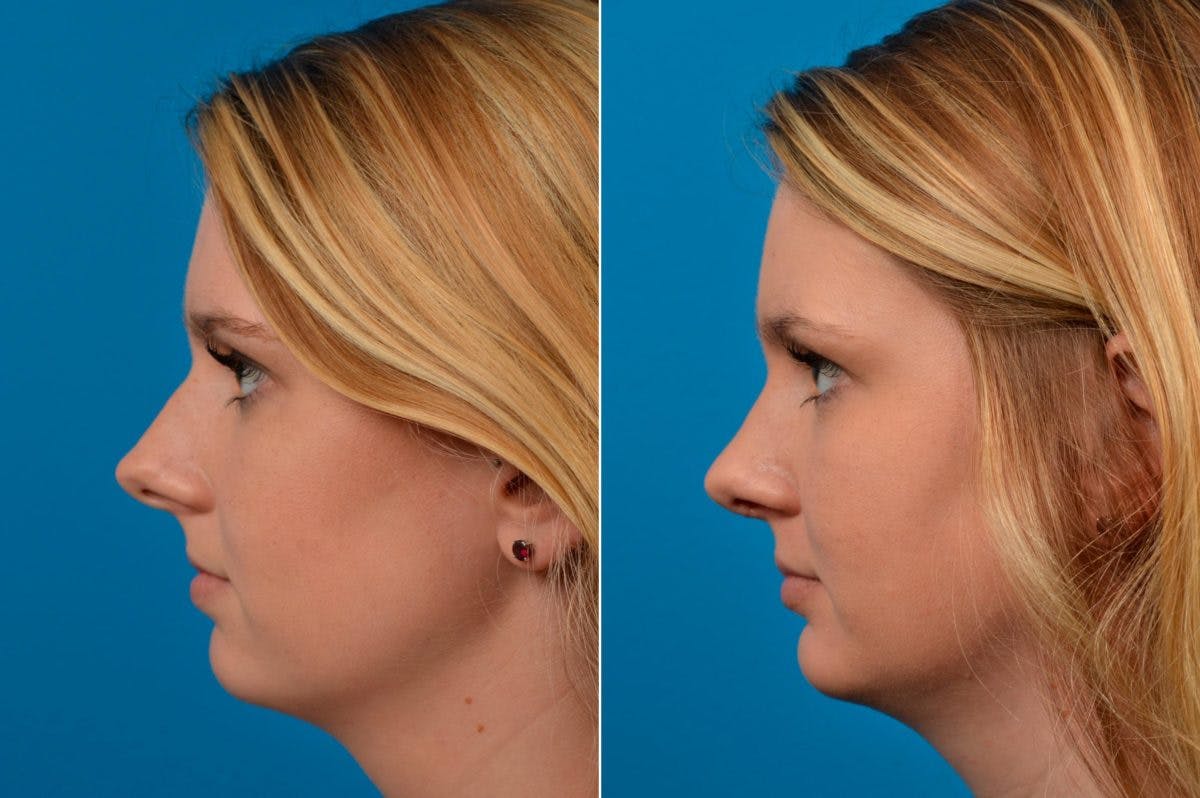 Chin Augmentation Before & After Gallery - Patient 122405576 - Image 2