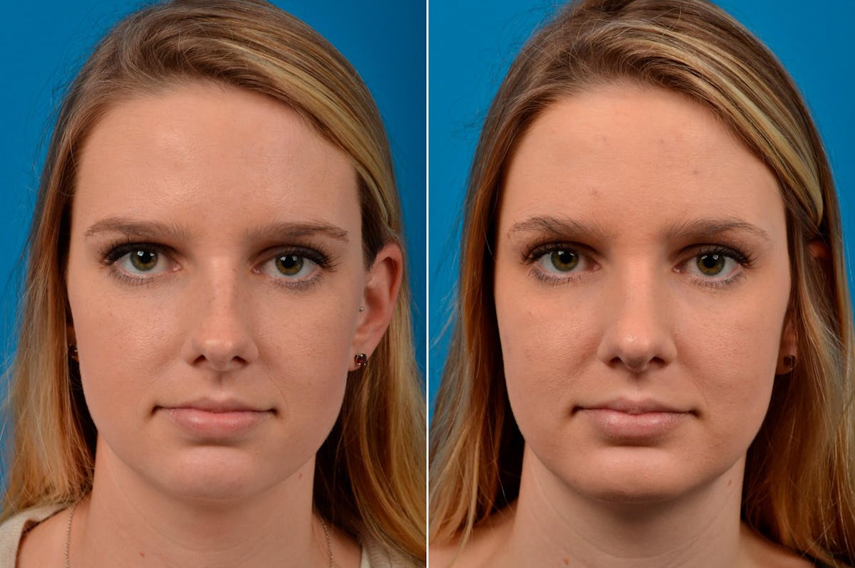 Chin Augmentation Before & After Gallery - Patient 122405576 - Image 3