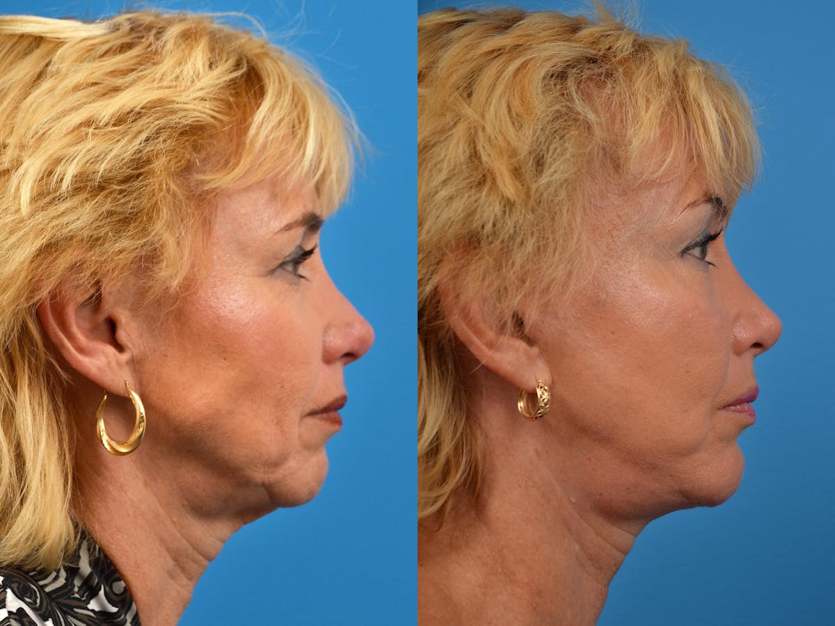 Chin Augmentation Before & After Gallery - Patient 122405584 - Image 1