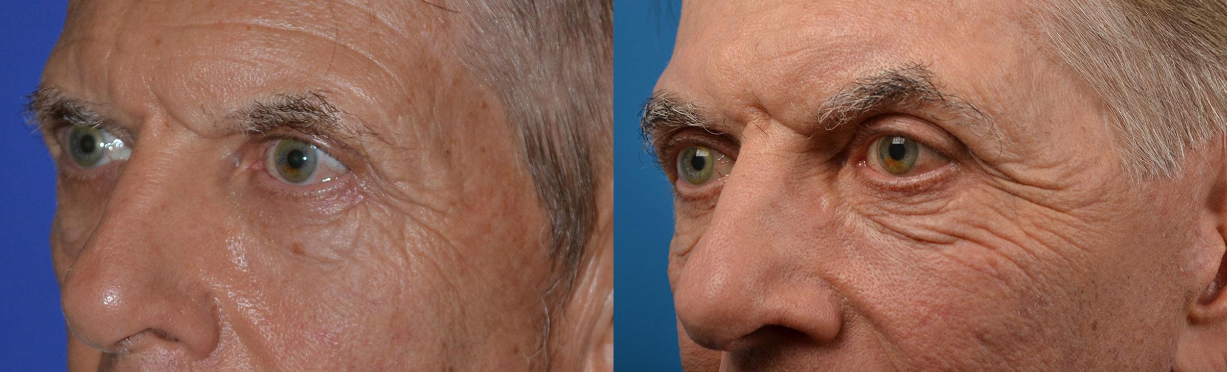 Brow Lift Before & After Gallery - Patient 122405580 - Image 8