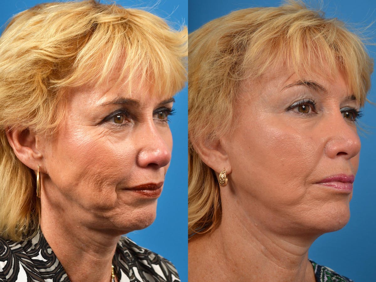 Chin Augmentation Before & After Gallery - Patient 122405584 - Image 2