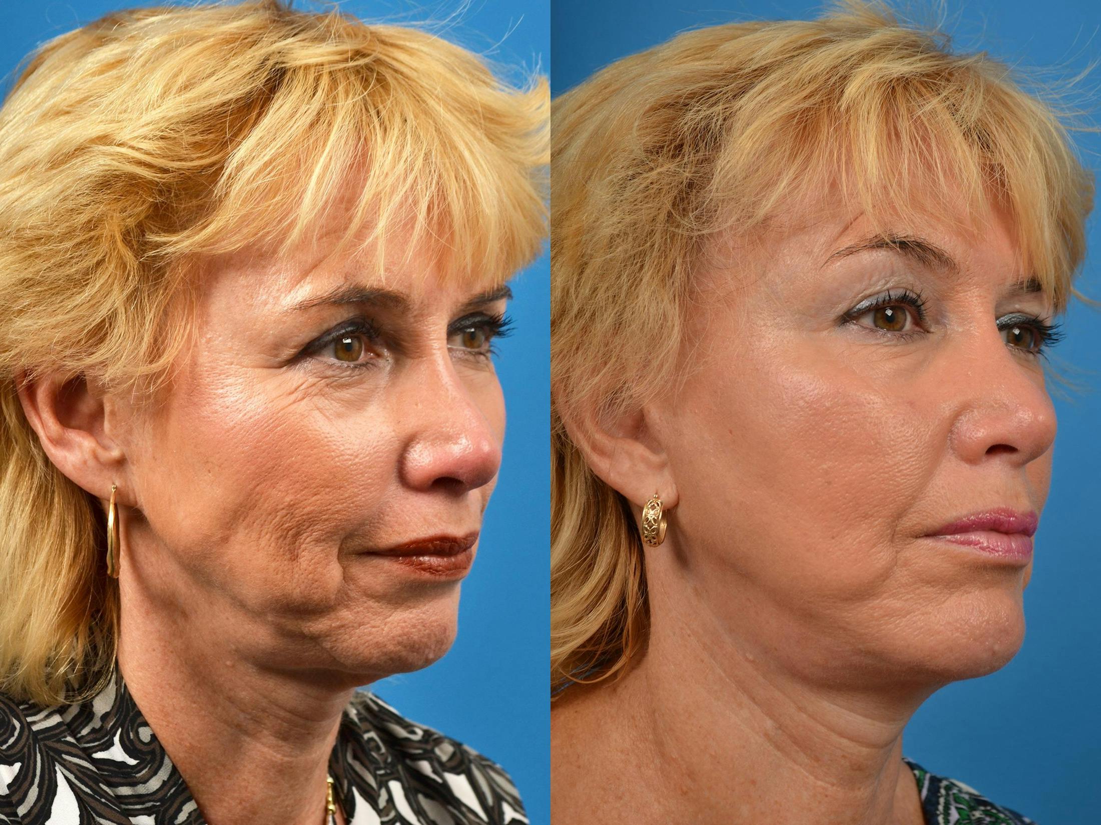 Chin Augmentation Before & After Gallery - Patient 122405584 - Image 2